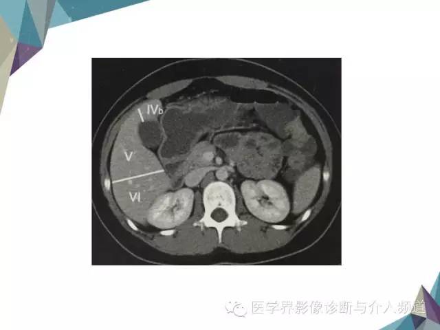 【PPT】肝脏影像学分段
