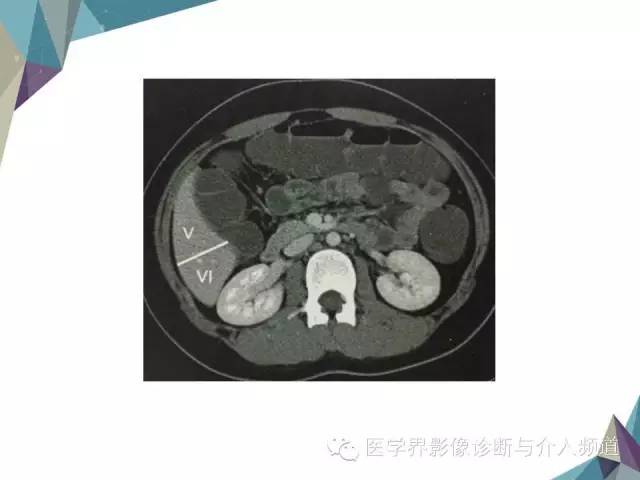 【PPT】肝脏影像学分段