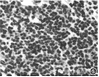 【病例】椎管内淋巴瘤1例MR影像表现 【病例】椎管内淋巴瘤1例MR影像表现