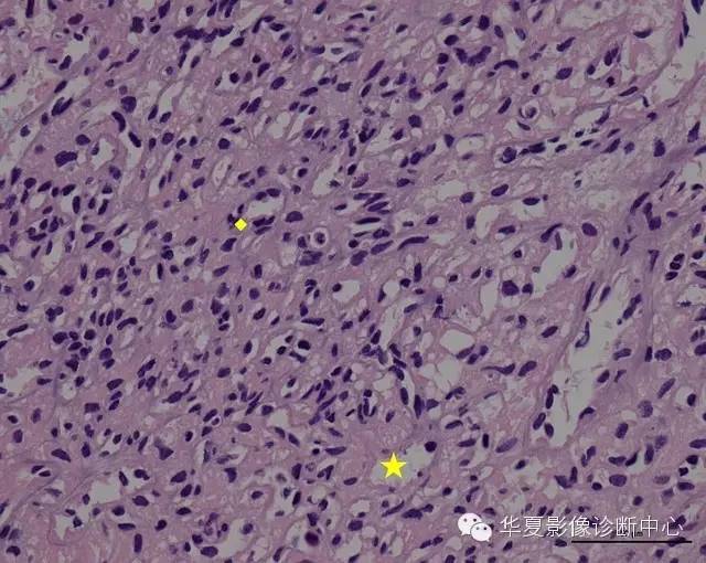【病例】中枢神经系统毛细血管瘤1例MR影像表现