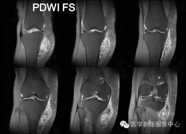 【病例】腱鞘巨细胞瘤1例MR影像表现