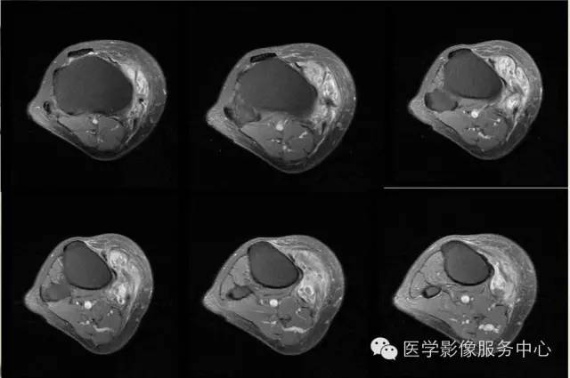 【病例】腱鞘巨细胞瘤1例MR影像表现 【病例】腱鞘巨细胞瘤1例MR影像表现
