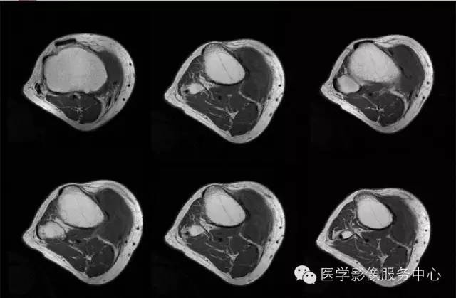 【病例】腱鞘巨细胞瘤1例MR影像表现 【病例】腱鞘巨细胞瘤1例MR影像表现