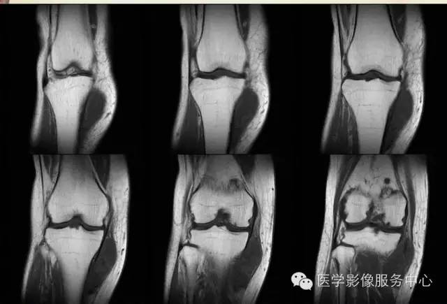 【病例】腱鞘巨细胞瘤1例MR影像表现 【病例】腱鞘巨细胞瘤1例MR影像表现