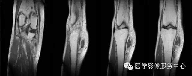 【病例】腱鞘巨细胞瘤1例MR影像表现 【病例】腱鞘巨细胞瘤1例MR影像表现