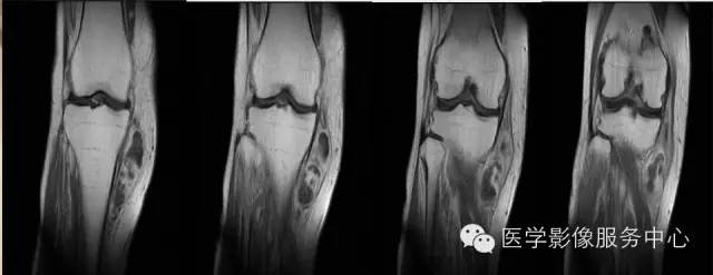 【病例】腱鞘巨细胞瘤1例MR影像表现 【病例】腱鞘巨细胞瘤1例MR影像表现