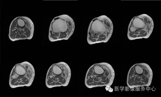 【病例】腱鞘巨细胞瘤1例MR影像表现 【病例】腱鞘巨细胞瘤1例MR影像表现