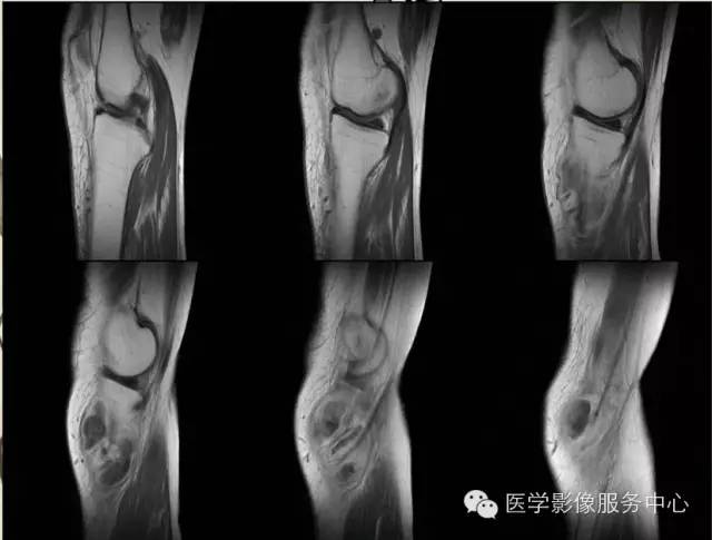 【病例】腱鞘巨细胞瘤1例MR影像表现 【病例】腱鞘巨细胞瘤1例MR影像表现