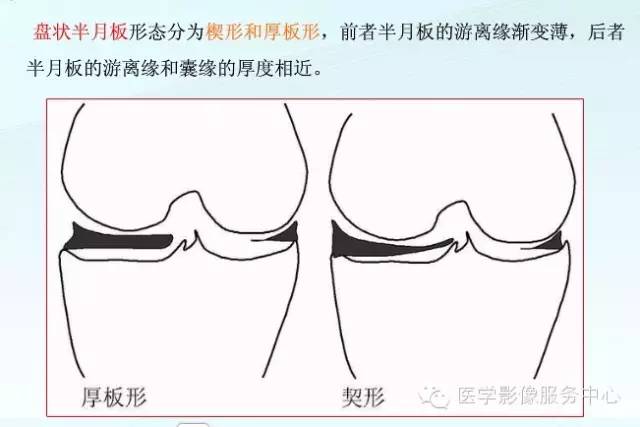 【病例】右膝关节外侧盘状半月板1例MR影像表现 【病例】右膝关节外侧盘状半月板1例MR影像表现