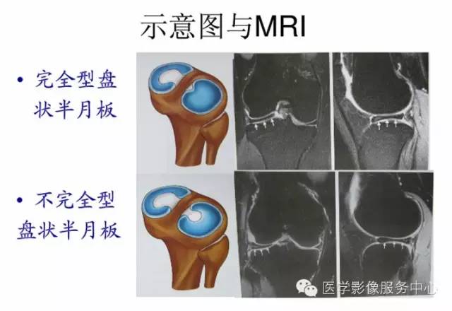 【病例】右膝关节外侧盘状半月板1例MR影像表现 【病例】右膝关节外侧盘状半月板1例MR影像表现