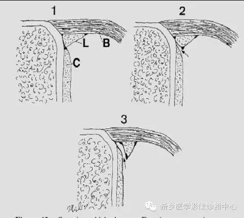 易误诊为盂唇撕裂的结构——上盂唇下隐窝