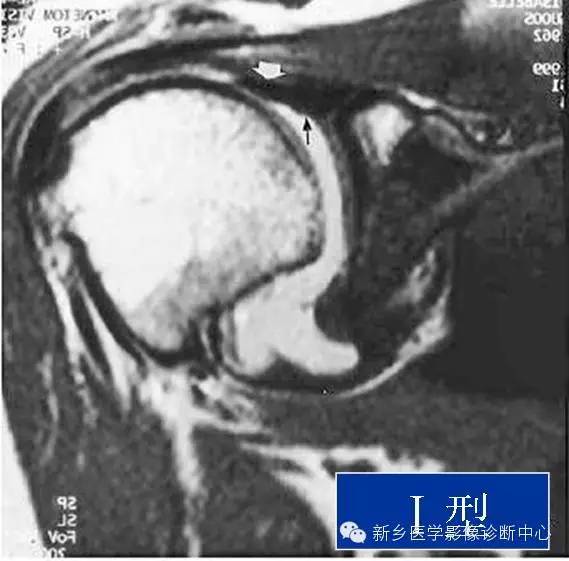 易误诊为盂唇撕裂的结构——上盂唇下隐窝
