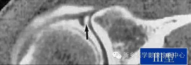 易误诊为盂唇撕裂的结构——上盂唇下隐窝