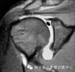 易误诊为盂唇撕裂的结构——上盂唇下隐窝