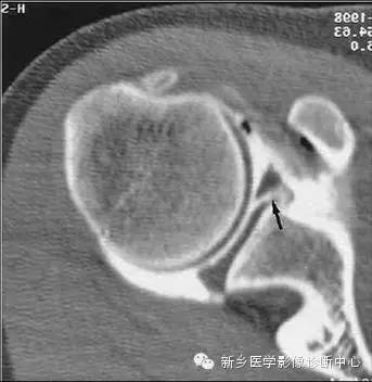 易误诊为盂唇撕裂的结构——上盂唇下隐窝