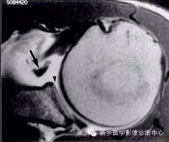 易误诊为盂唇撕裂的结构——上盂唇下隐窝