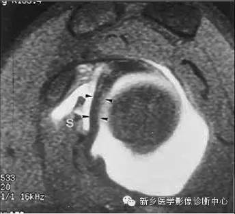 易误诊为盂唇撕裂的结构——上盂唇下隐窝