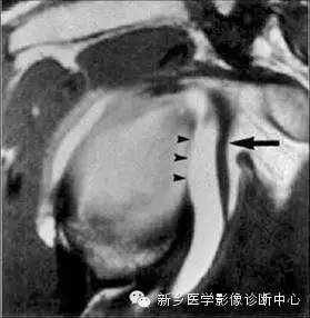 易误诊为盂唇撕裂的结构——上盂唇下隐窝