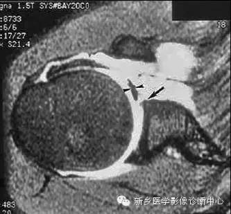易误诊为盂唇撕裂的结构——上盂唇下隐窝