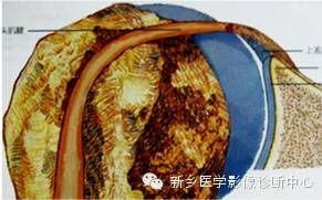 易误诊为盂唇撕裂的结构——上盂唇下隐窝