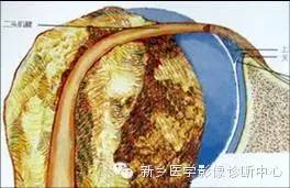 易误诊为盂唇撕裂的结构——上盂唇下隐窝