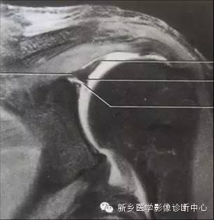 易误诊为盂唇撕裂的结构——上盂唇下隐窝
