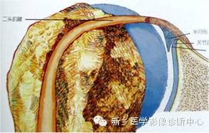 易误诊为盂唇撕裂的结构——上盂唇下隐窝