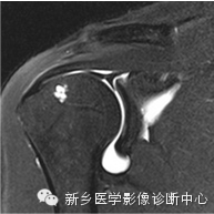 易误诊为盂唇撕裂的结构——上盂唇下隐窝