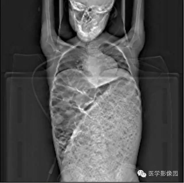 【病例】先天性巨结肠1例CT影像表现