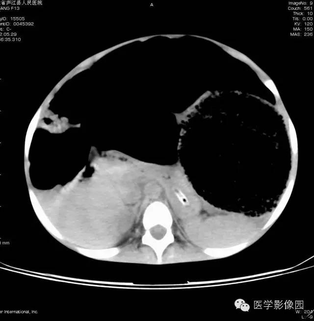 【病例】先天性巨结肠1例CT影像表现 【病例】先天性巨结肠1例CT影像表现