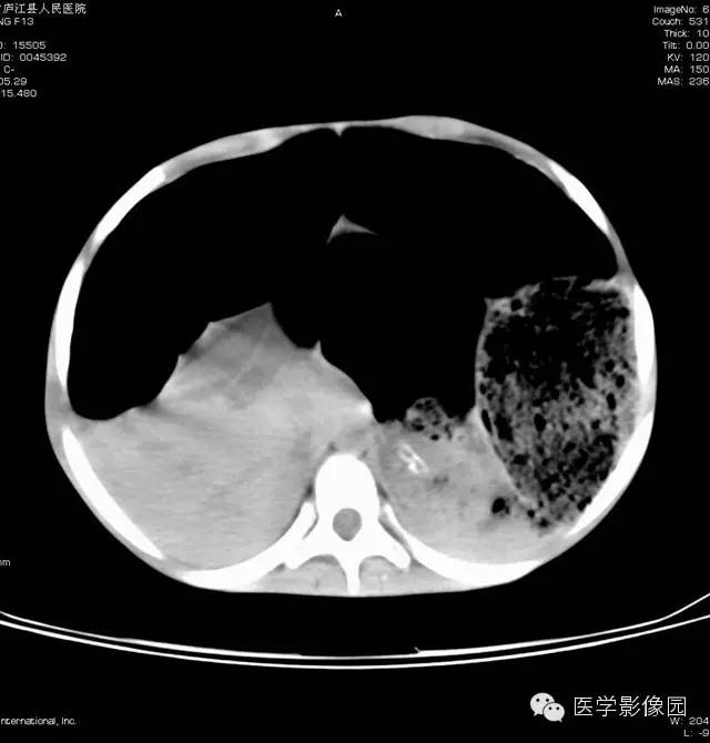 【病例】先天性巨结肠1例CT影像表现 【病例】先天性巨结肠1例CT影像表现