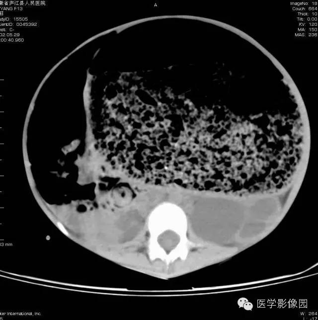 【病例】先天性巨结肠1例CT影像表现 【病例】先天性巨结肠1例CT影像表现