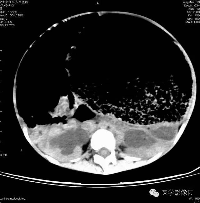 【病例】先天性巨结肠1例CT影像表现 【病例】先天性巨结肠1例CT影像表现
