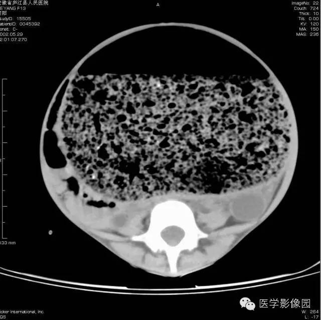 【病例】先天性巨结肠1例CT影像表现 【病例】先天性巨结肠1例CT影像表现