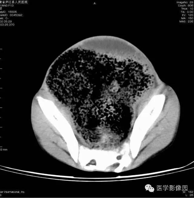 【病例】先天性巨结肠1例CT影像表现 【病例】先天性巨结肠1例CT影像表现
