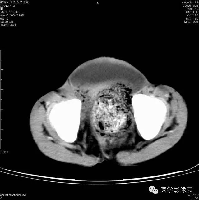 【病例】先天性巨结肠1例CT影像表现 【病例】先天性巨结肠1例CT影像表现