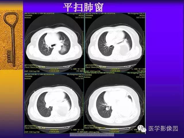 【病例】胸部孤立性纤维瘤1例CT影像表现 【病例】胸部孤立性纤维瘤1例CT影像表现