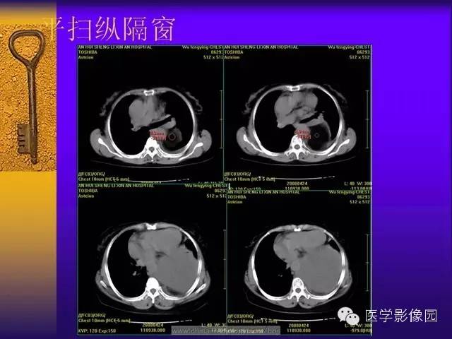 【病例】胸部孤立性纤维瘤1例CT影像表现 【病例】胸部孤立性纤维瘤1例CT影像表现