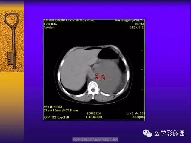 【病例】胸部孤立性纤维瘤1例CT影像表现 【病例】胸部孤立性纤维瘤1例CT影像表现