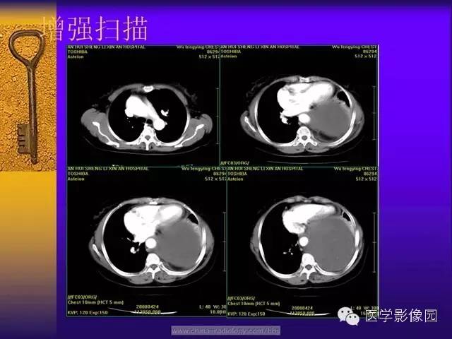 【病例】胸部孤立性纤维瘤1例CT影像表现 【病例】胸部孤立性纤维瘤1例CT影像表现