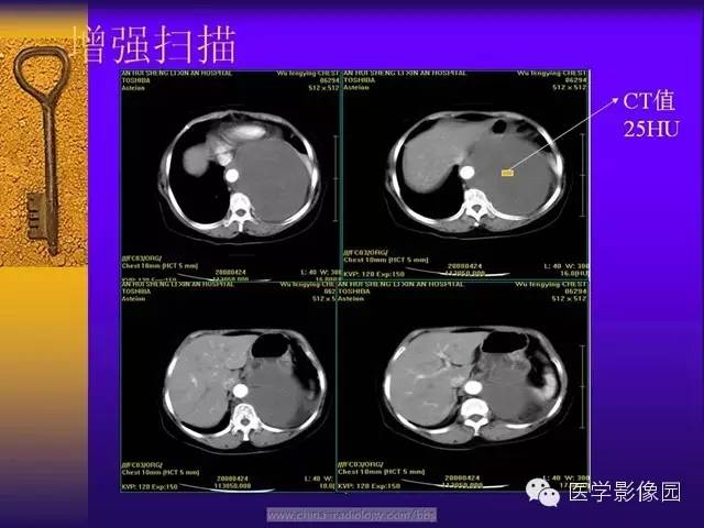 【病例】胸部孤立性纤维瘤1例CT影像表现 【病例】胸部孤立性纤维瘤1例CT影像表现
