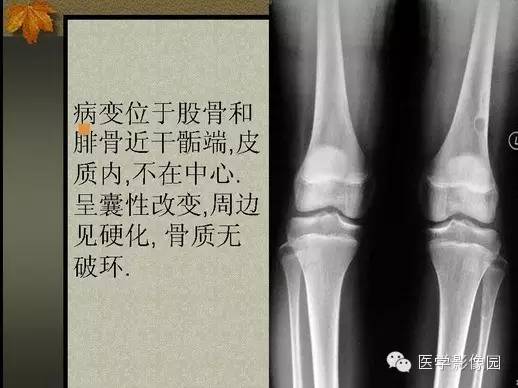 【PPT】纤维骨皮质缺损的影像诊断