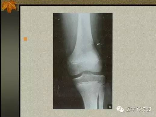 【PPT】纤维骨皮质缺损的影像诊断