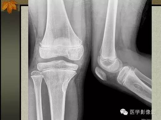 【PPT】纤维骨皮质缺损的影像诊断