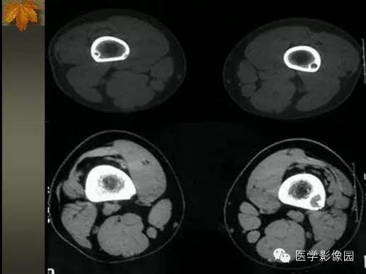 【PPT】纤维骨皮质缺损的影像诊断
