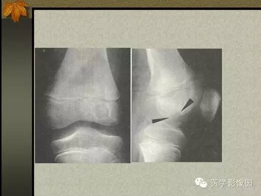 【PPT】纤维骨皮质缺损的影像诊断