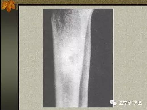 【PPT】纤维骨皮质缺损的影像诊断