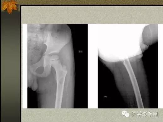 【PPT】纤维骨皮质缺损的影像诊断