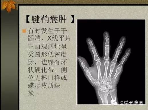 【PPT】纤维骨皮质缺损的影像诊断