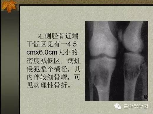 【PPT】纤维骨皮质缺损的影像诊断
